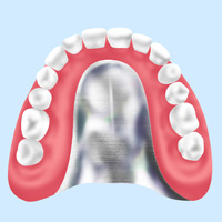 金属床入れ歯